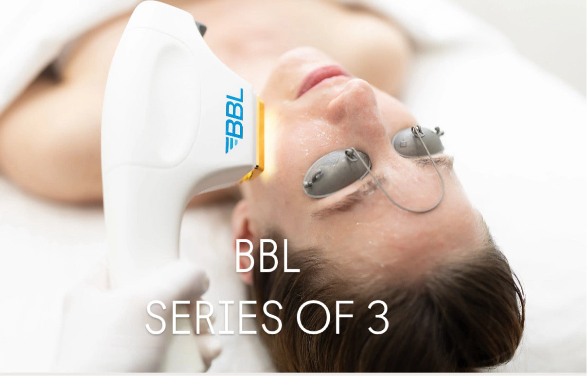 * BBL Forever Young Photofacial Series of 3: FACE 20% Off