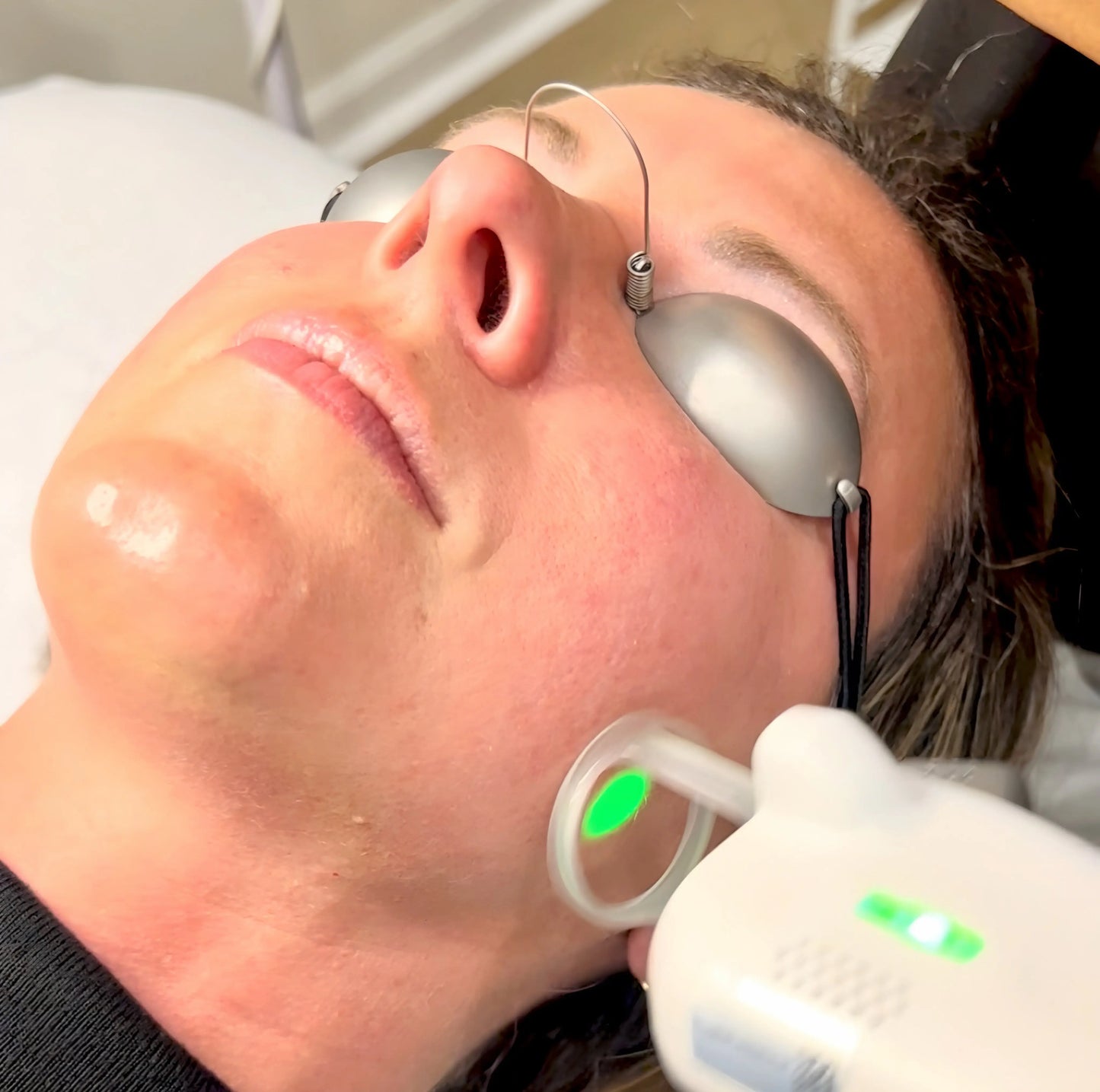 * KOREAN GLASS SKIN LASER FACIAL The Skinscience Shop