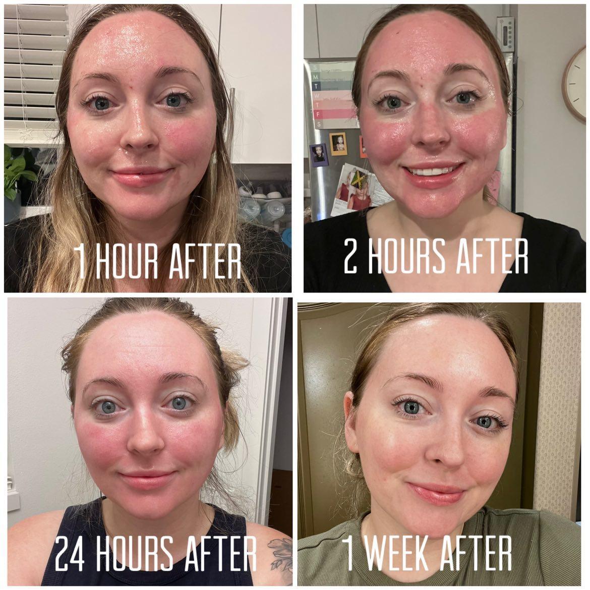 * CO2 Laser Skin Resurfacing (Level 1)