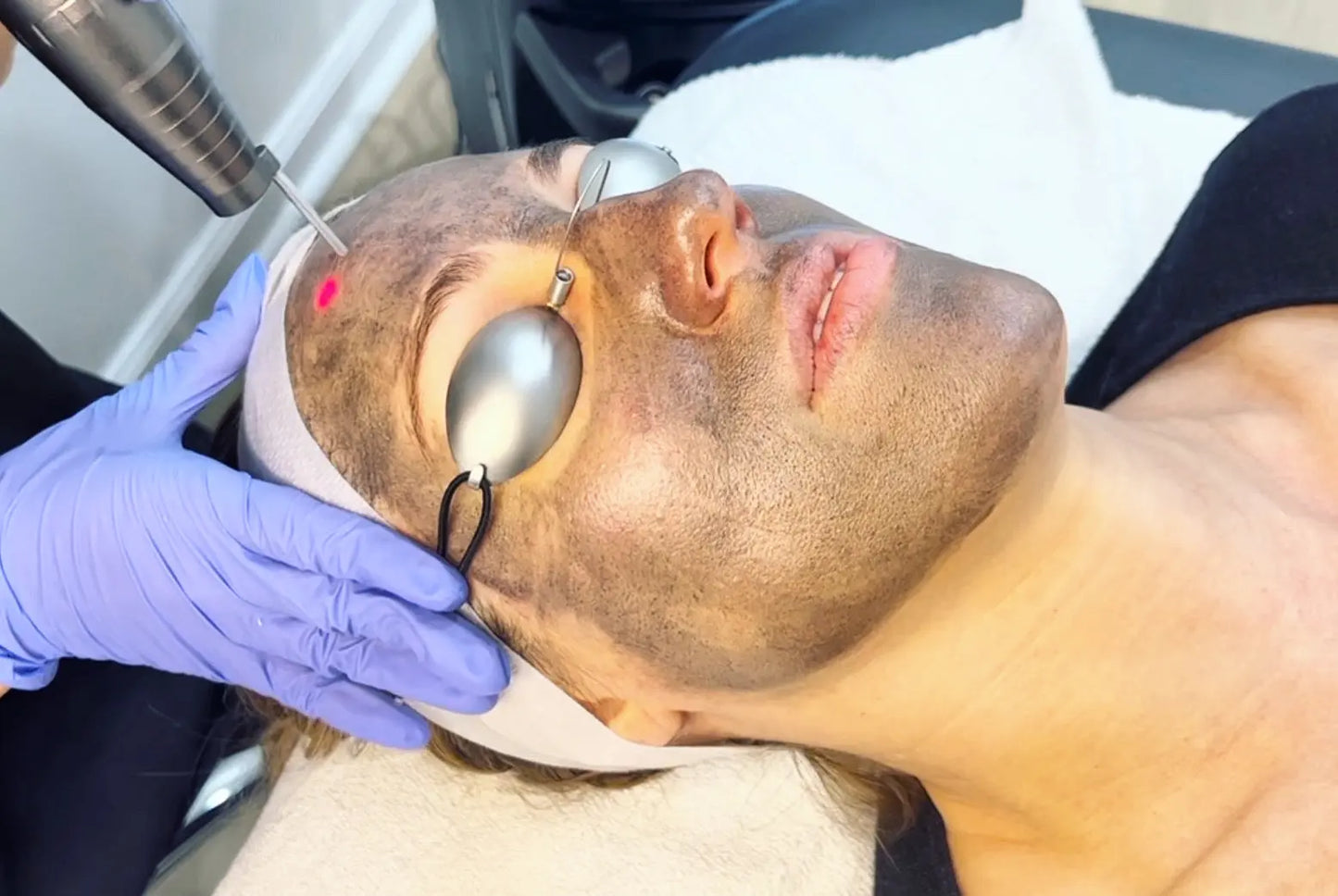 * HOLLYWOOD LASER PEEL The Skinscience Shop