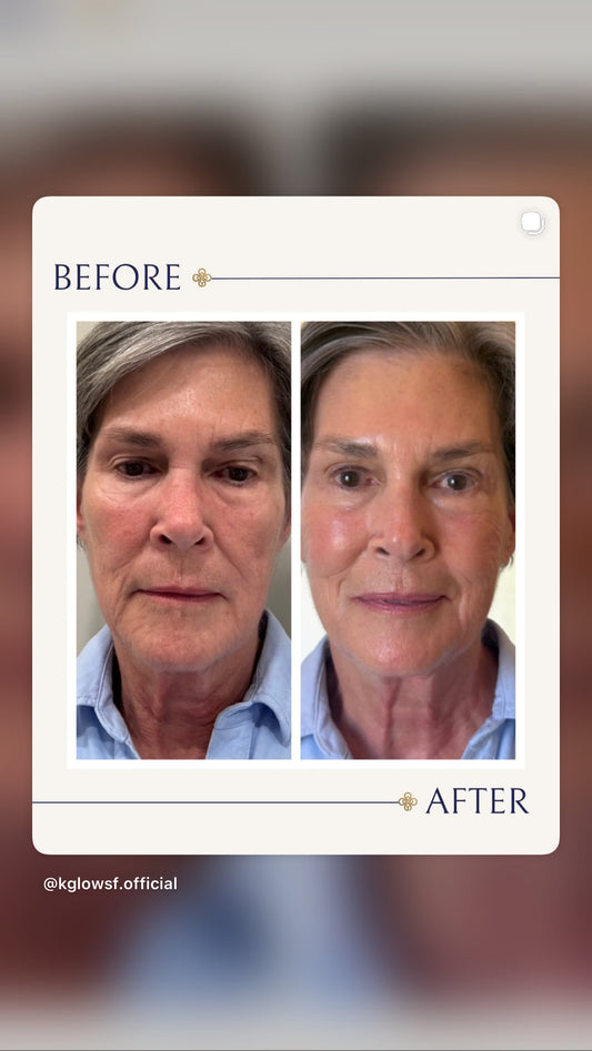 * (Roll-out Deal) XERFing USA! THE AMAZING OFFER: Tighten & Brighten!: You get: 2 XERFs (Reg $3600) + $500 Voucher toward a MOXI (Reg $750) (TAP HERE for full description)