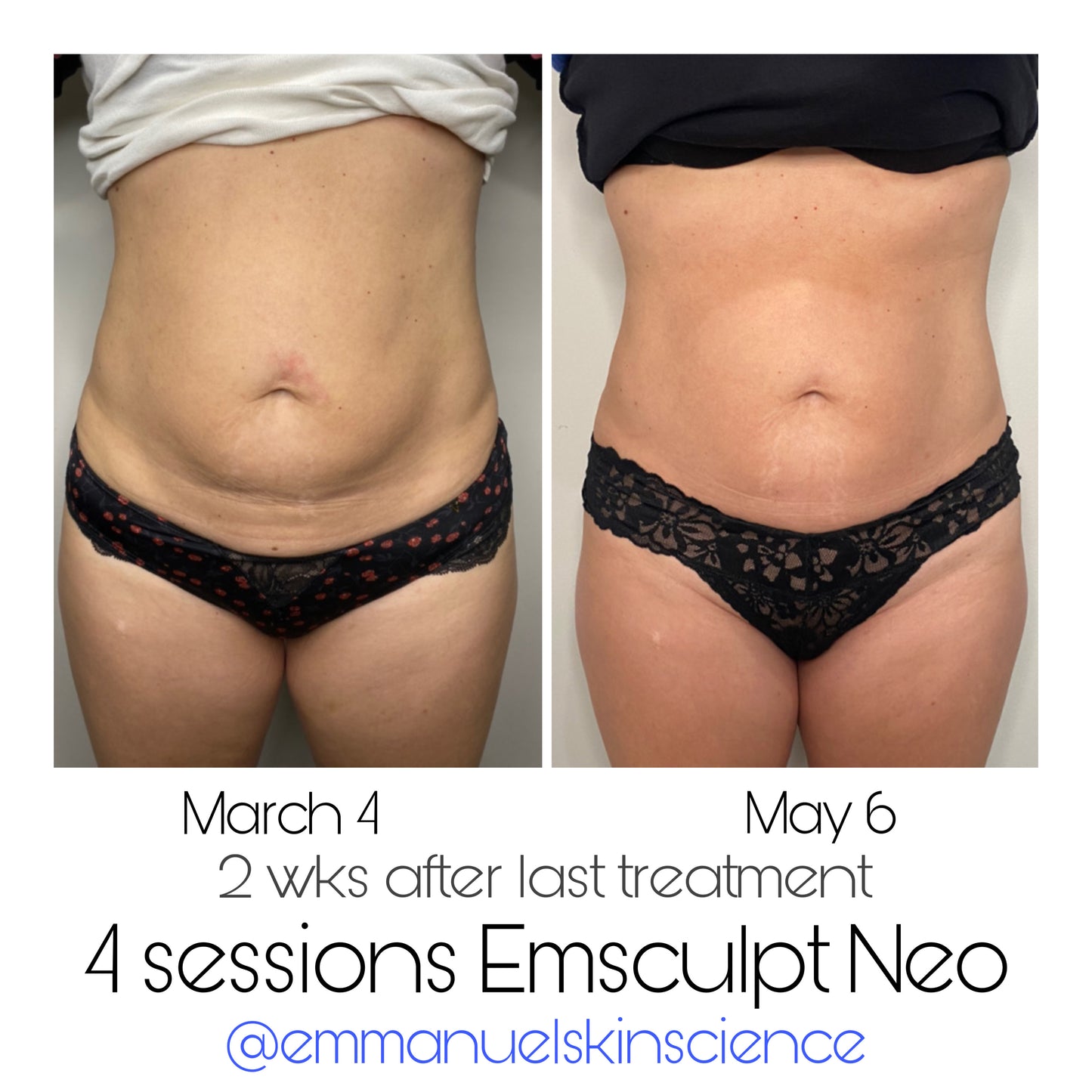 * EMSCULPT NEO: 4 Sessions